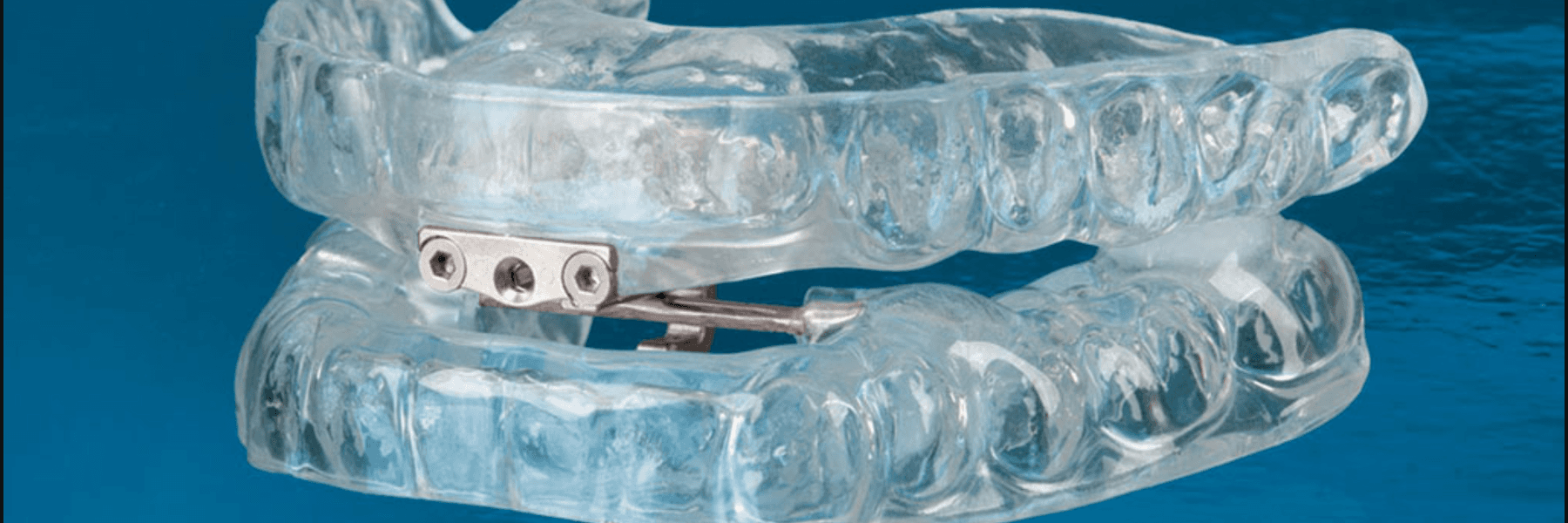 Oral Appliances for Sleep Apnea | Dentist